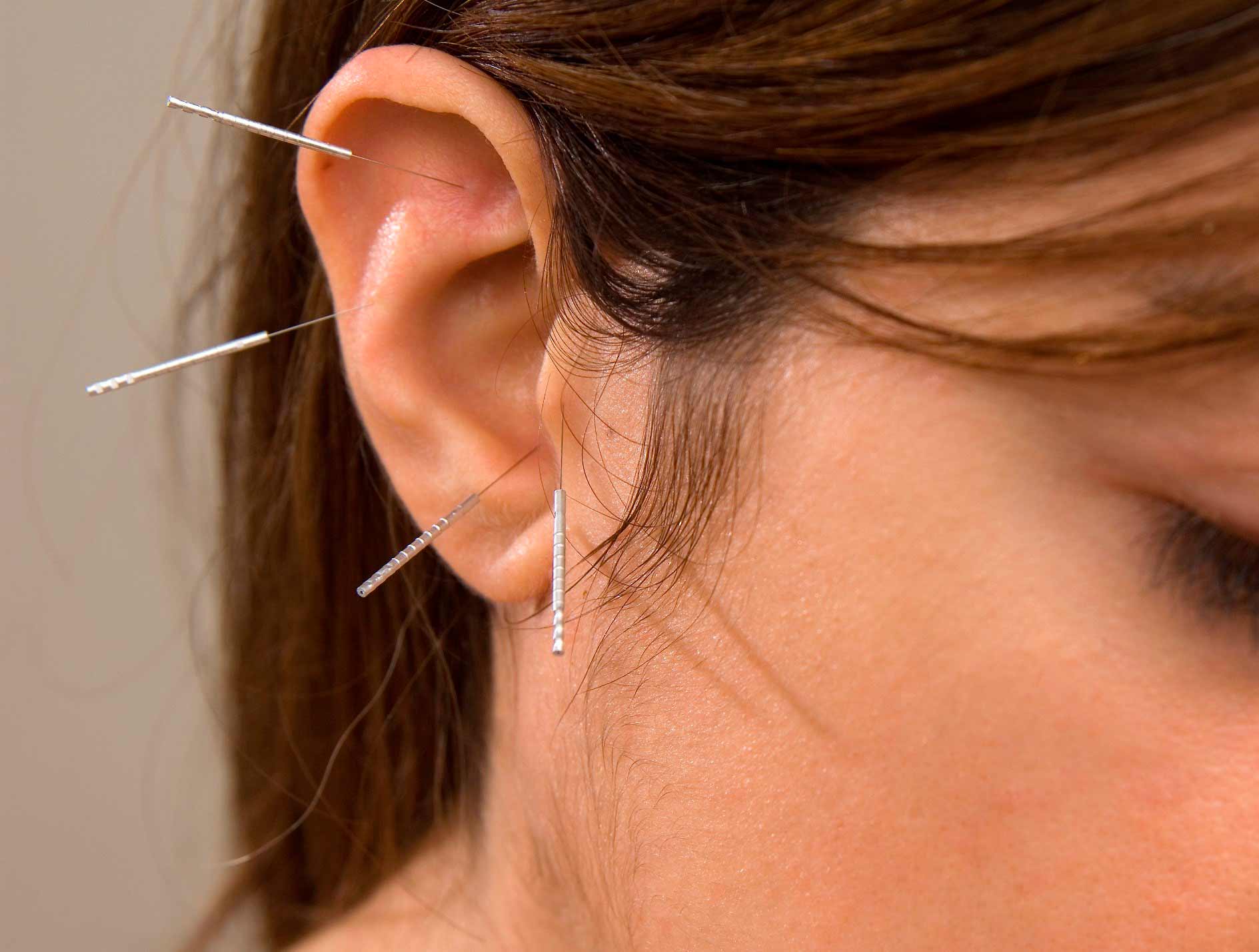 oor acupunctuur